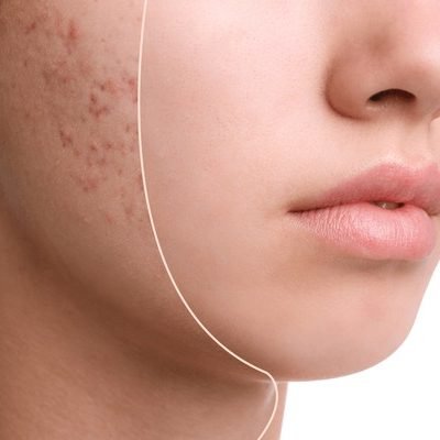 Acne facial Glendale