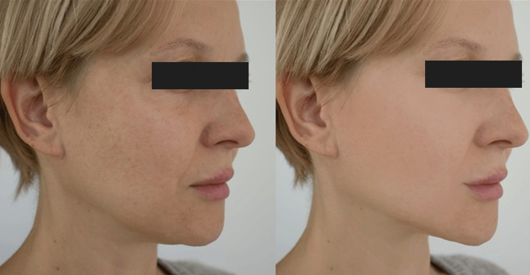 Facials-before-and-after 11