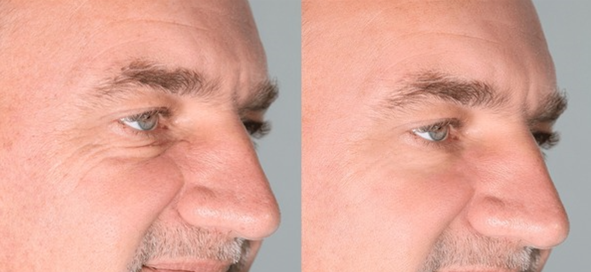 Facials-before-and-after 13