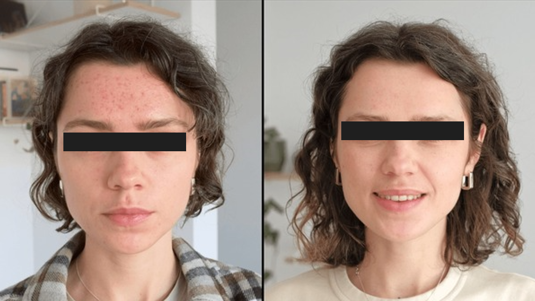 Facials-before-and-after